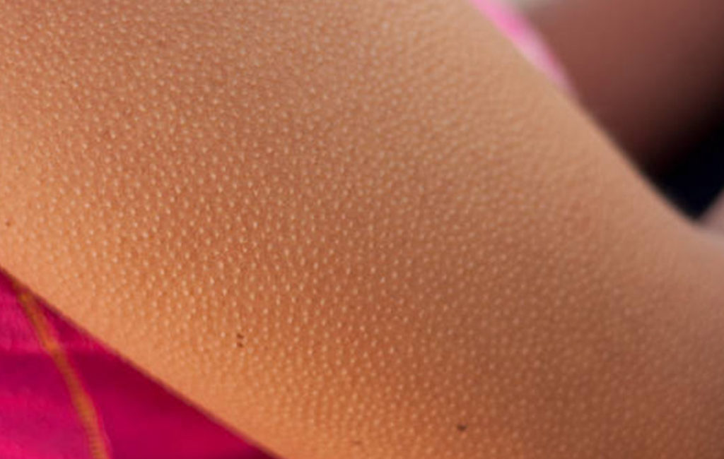 Understanding The Skin Condition Keratosis Pilaris