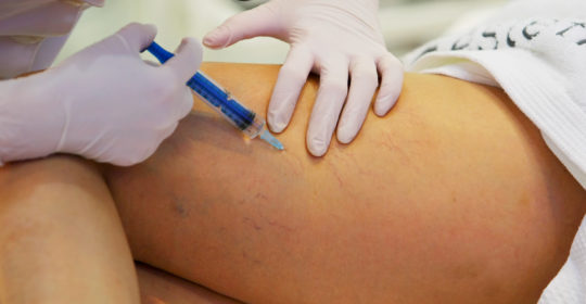 Sclerotherapy injection for varicose veins