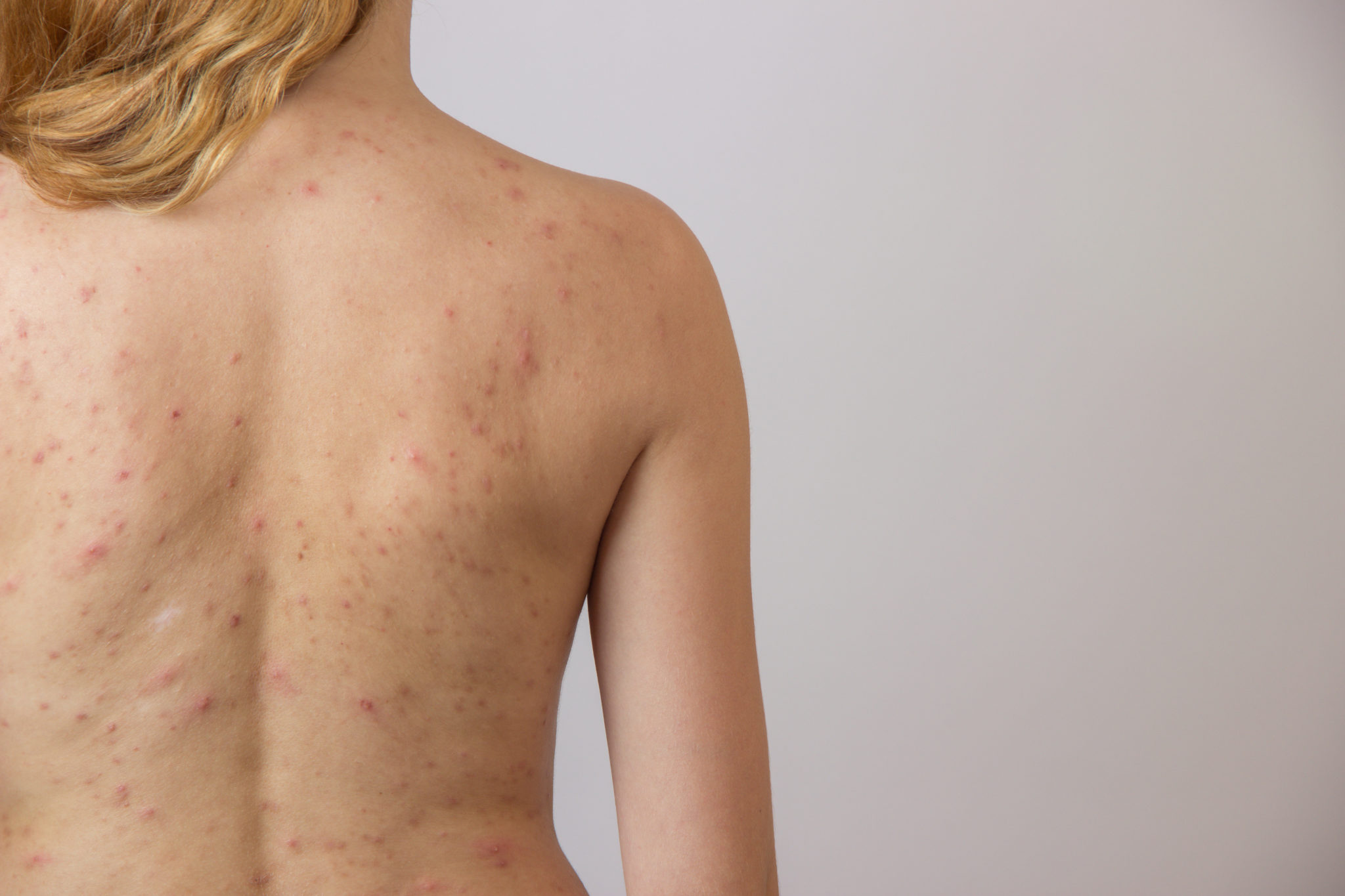 Acne on the back of men: how to fight Acne on the back of men: how to fight