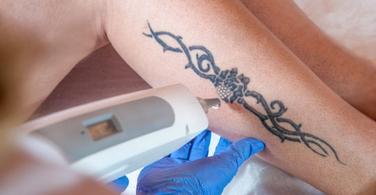 laser tattoo removal