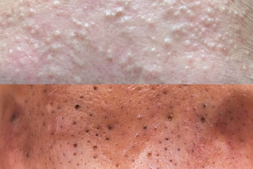 blackheads-vs-whiteheads-the-pretty-pimple