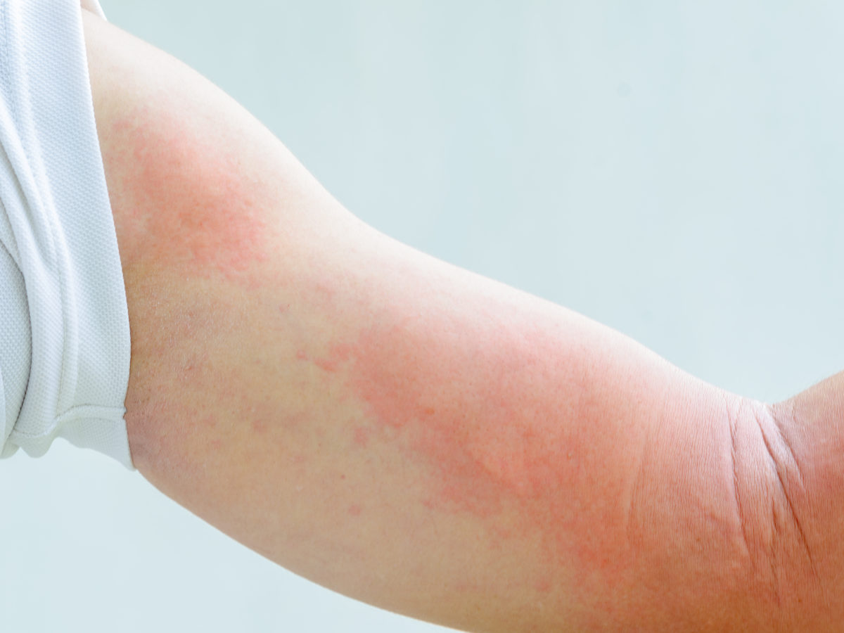 hives urticaria