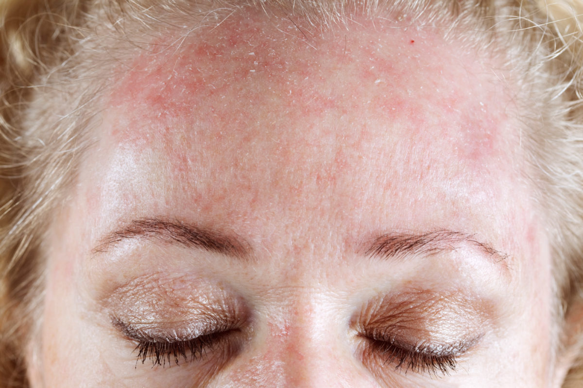 Scaly Scalp You May Have Seborrheic Dermatitis The Pretty Pimple