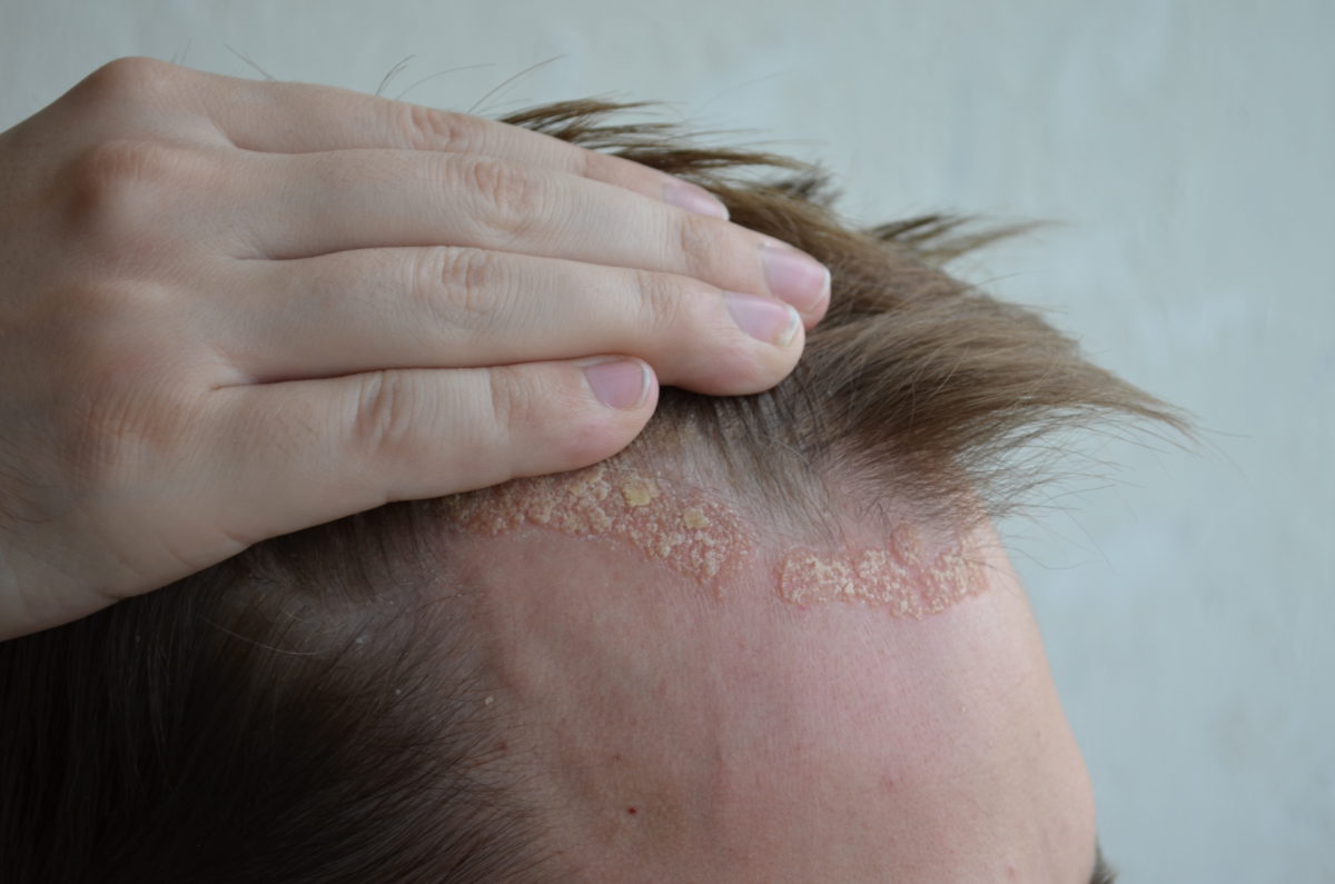 scaly-scalp-you-may-have-seborrheic-dermatitis-the-pretty-pimple