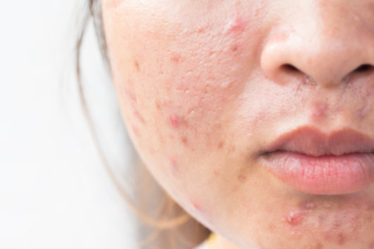 How To Control Pimples On Face Naturally How To Control Pimples On Face Naturally