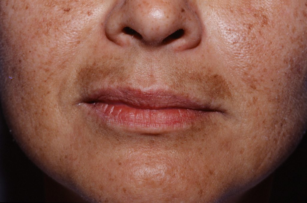 melasma emulsion