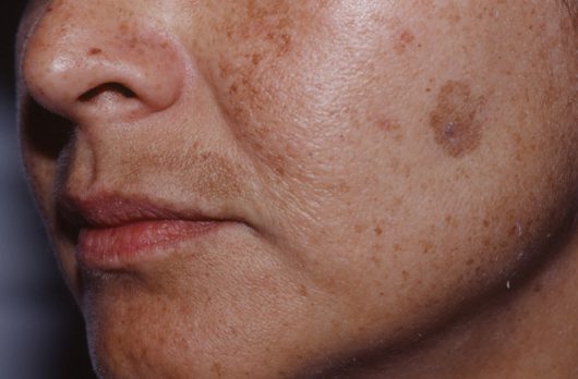 your-guide-to-melasma-how-to-treat-tricky-dark-spots-the-pretty-pimple