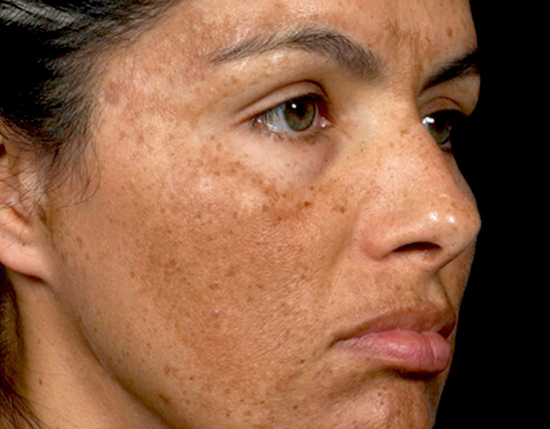 your-guide-to-melasma-how-to-treat-tricky-dark-spots-the-pretty-pimple