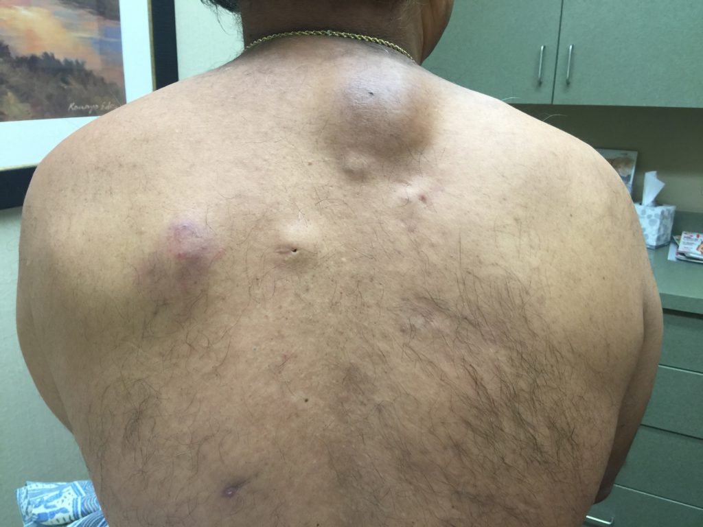 Do You Find Them Irre CYST able A Simple Cyst Primer The Pretty Pimple