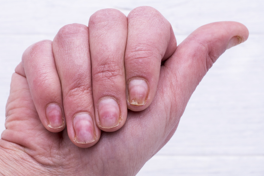 Got Thin Peeling Or Cracked Nails Here Are 6 Reasons Why The 